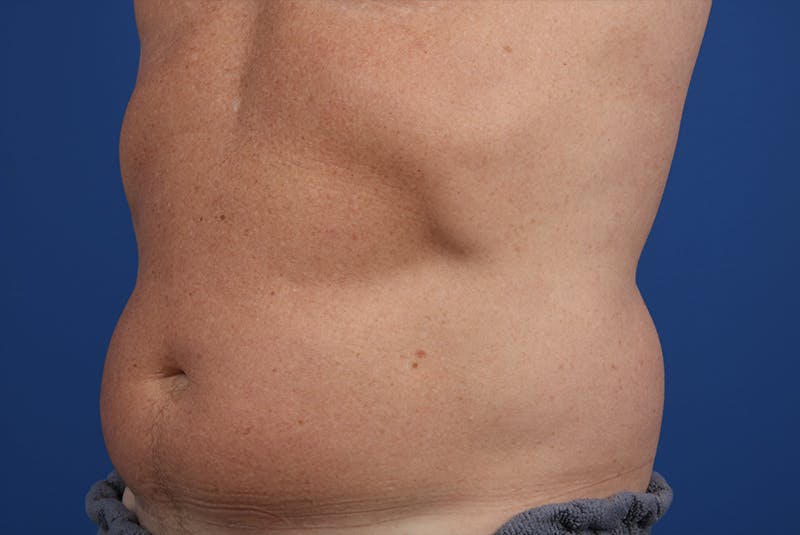 Coolsculpting Gallery - Patient 20437143 - Image 3