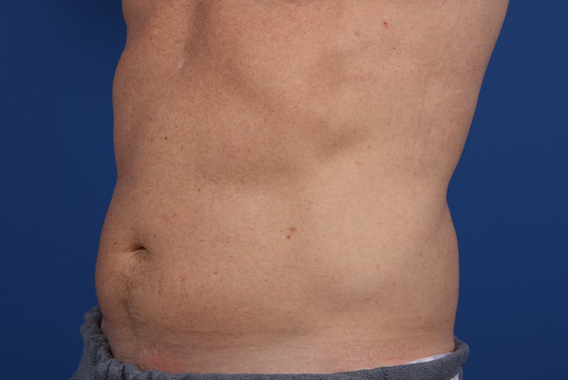 Coolsculpting Before & After Gallery - Patient 20437143 - Image 4