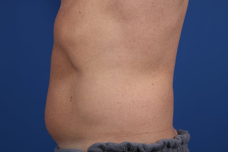 Coolsculpting Before & After Gallery - Patient 20437143 - Image 5