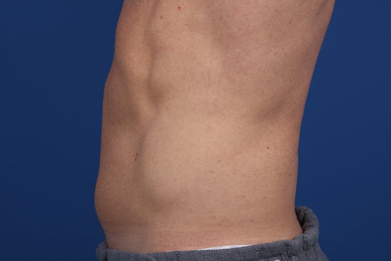 Coolsculpting Before & After Gallery - Patient 20437143 - Image 6