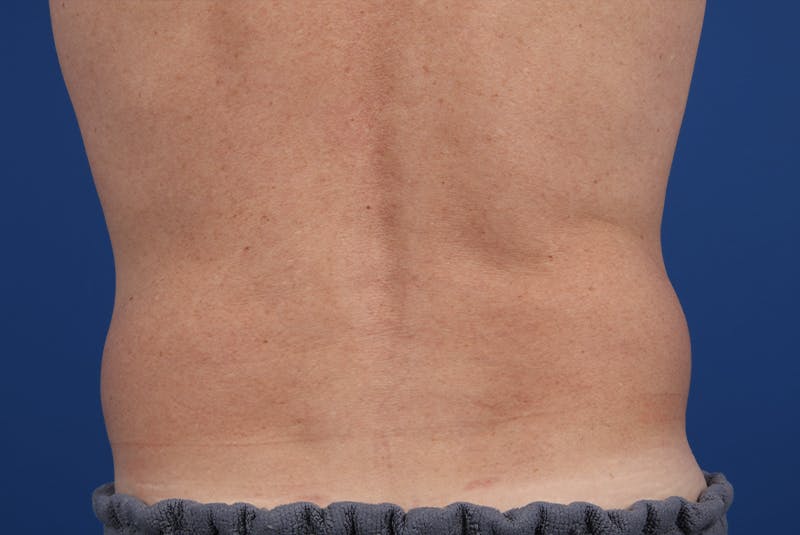 Coolsculpting Gallery - Patient 20437143 - Image 7