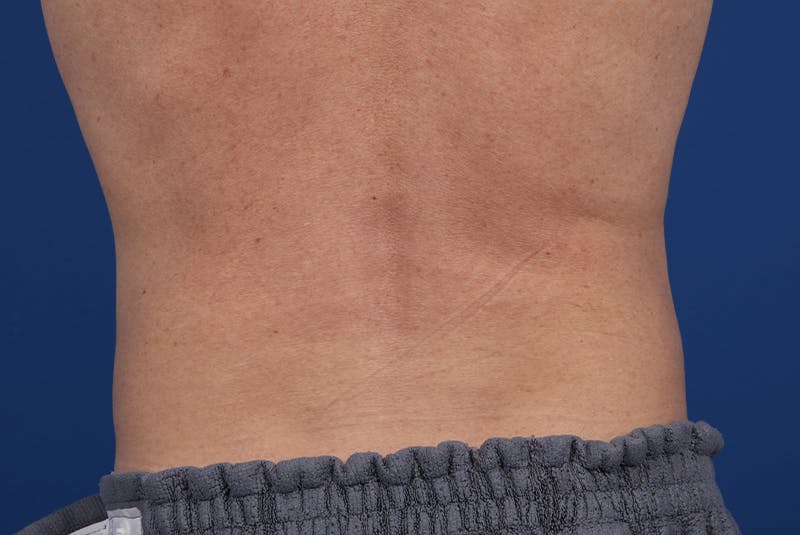 Coolsculpting Gallery - Patient 20437143 - Image 8