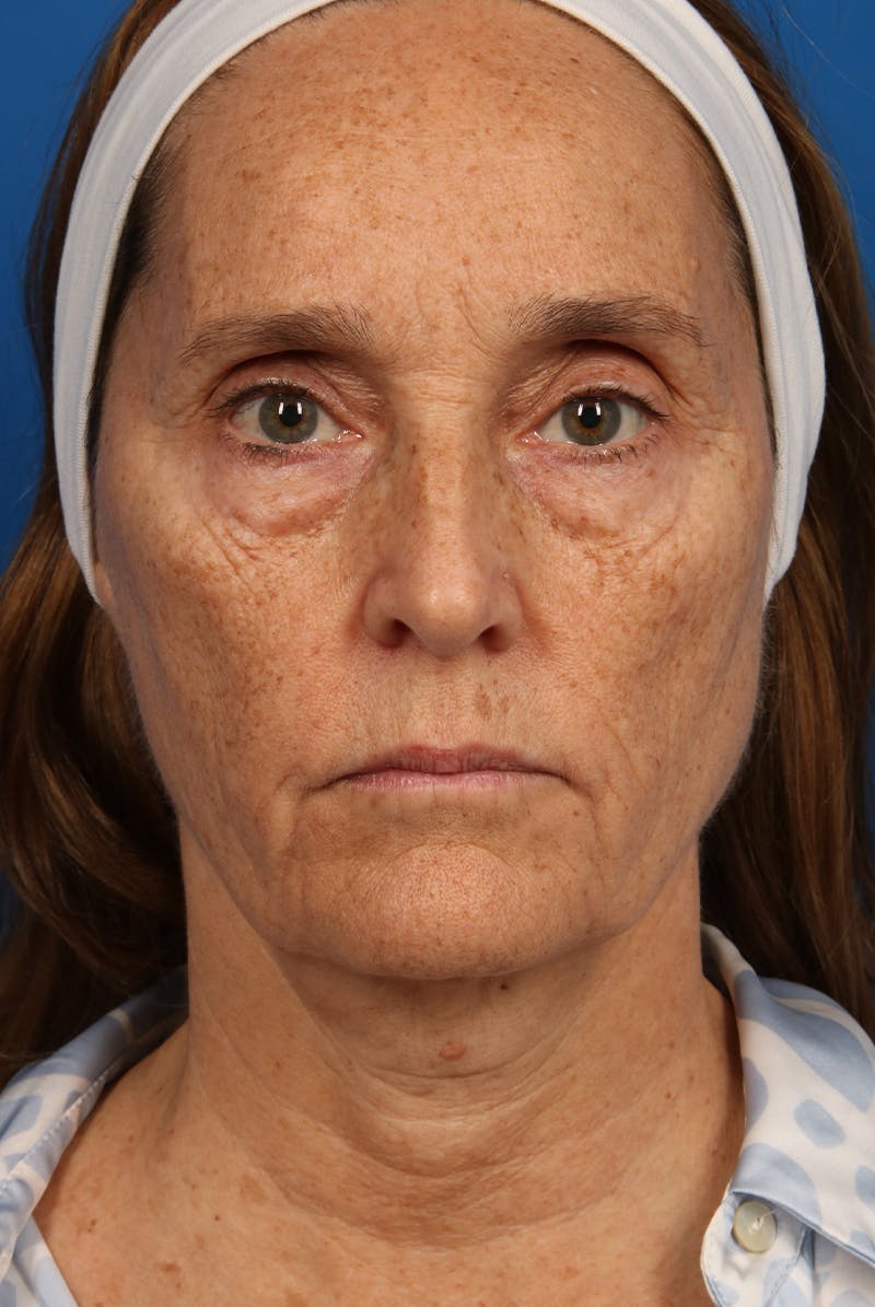 Laser Skin Resurfacing Before & After Gallery - Patient 26380158 - Image 1