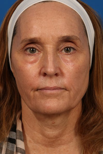 Laser Skin Resurfacing Before & After Gallery - Patient 26380158 - Image 2