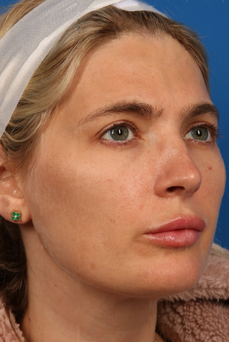 Laser Skin Resurfacing Before & After Gallery - Patient 31951299 - Image 1