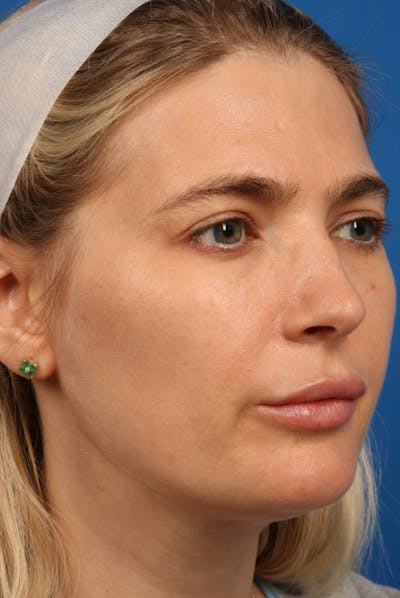 Laser Skin Resurfacing Before & After Gallery - Patient 31951299 - Image 2