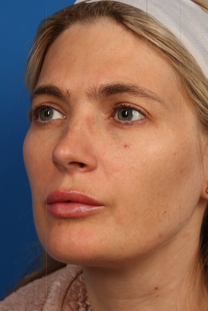 Laser Skin Resurfacing Before & After Gallery - Patient 31951299 - Image 3