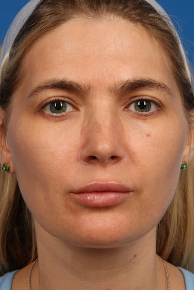 Laser Skin Resurfacing Before & After Gallery - Patient 31951299 - Image 1