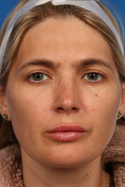 Laser Skin Resurfacing Before & After Gallery - Patient 31951299 - Image 2
