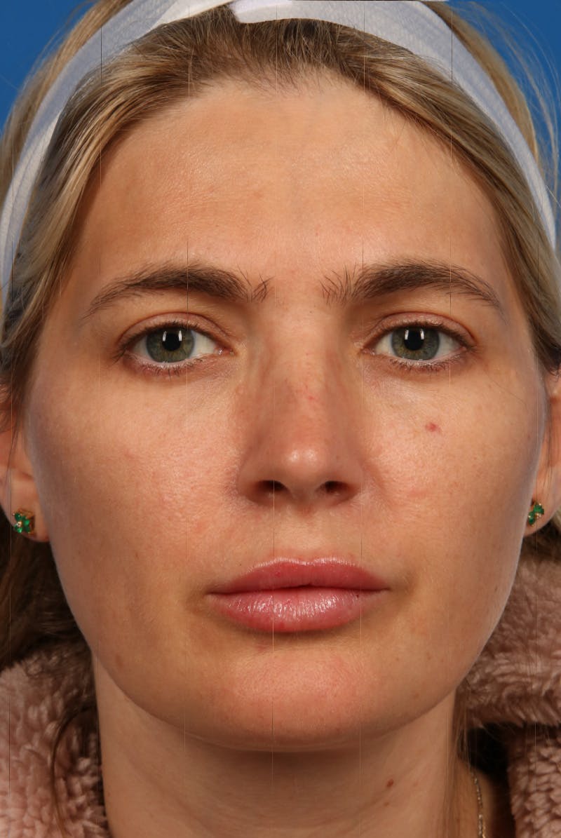 Laser Skin Resurfacing Before & After Gallery - Patient 31951299 - Image 6