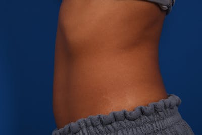 Coolsculpting Before & After Gallery - Patient 54831426 - Image 2