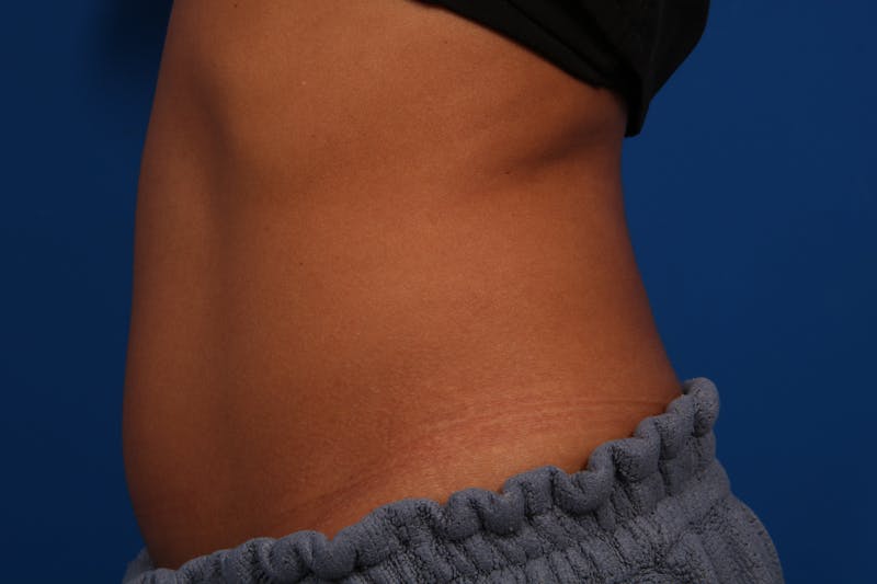 Coolsculpting Gallery - Patient 54831426 - Image 1