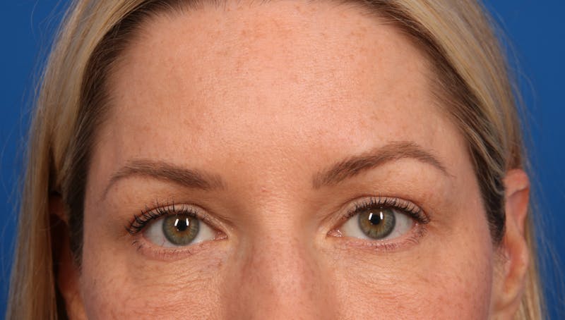 Upper Blepharoplasty Before & After Gallery - Patient 138060767 - Image 2