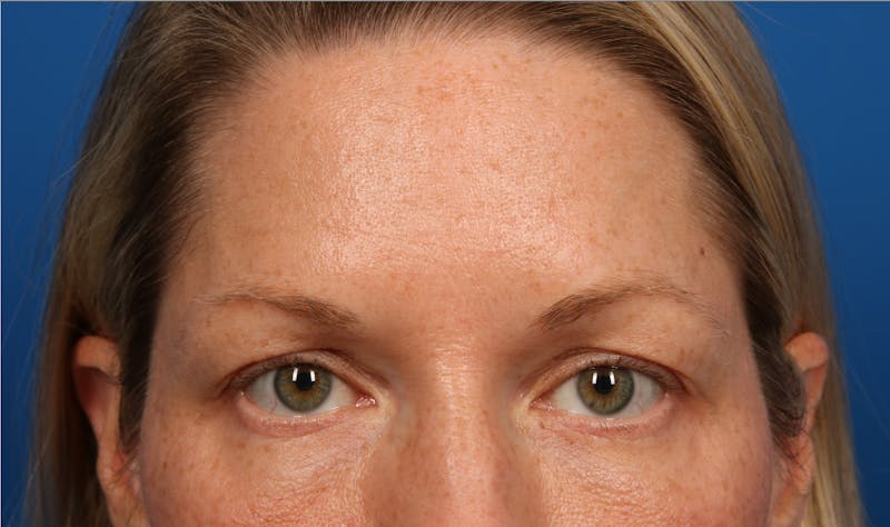 Quad Blepharoplasty Before & After Gallery - Patient 138062351 - Image 1