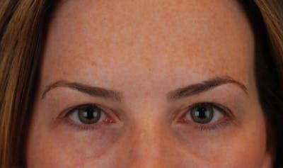 Upper Blepharoplasty Before & After Gallery - Patient 177619117 - Image 1