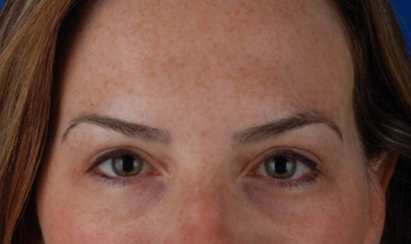 Upper Blepharoplasty Before & After Gallery - Patient 177619117 - Image 2