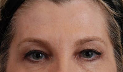 Upper Blepharoplasty Before & After Gallery - Patient 177619118 - Image 1
