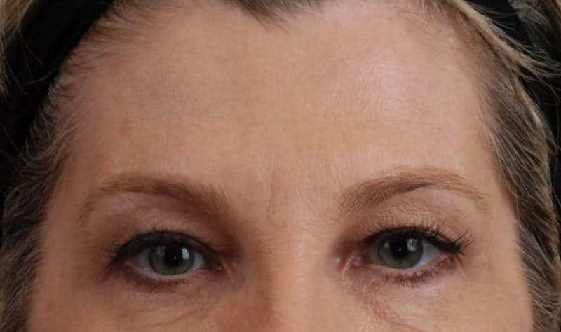 Upper Blepharoplasty Before & After Gallery - Patient 177619118 - Image 1