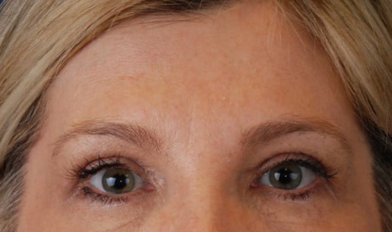 Upper Blepharoplasty Before & After Gallery - Patient 177619118 - Image 2