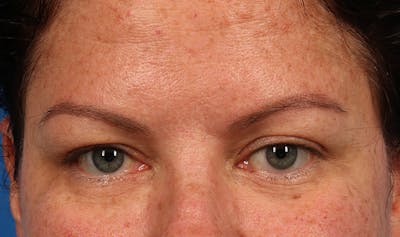 Upper Blepharoplasty Before & After Gallery - Patient 177619119 - Image 1