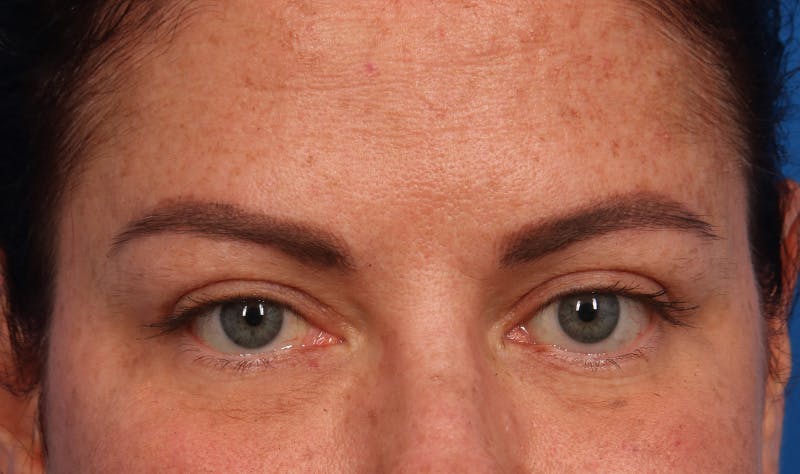Upper Blepharoplasty Before & After Gallery - Patient 177619119 - Image 2