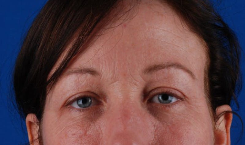 Quad Blepharoplasty Before & After Gallery - Patient 12974031 - Image 1