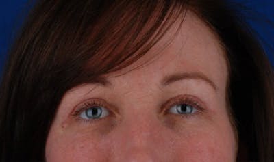 Quad Blepharoplasty Before & After Gallery - Patient 12974031 - Image 2