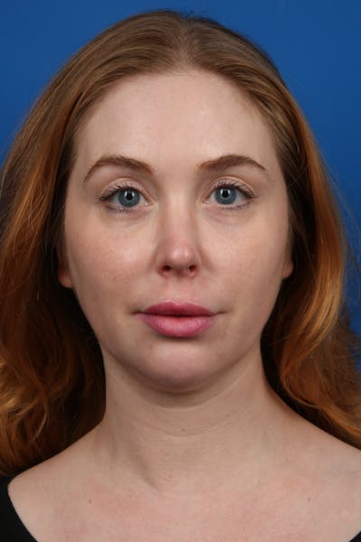 Botox Before & After Gallery - Patient 345145 - Image 2