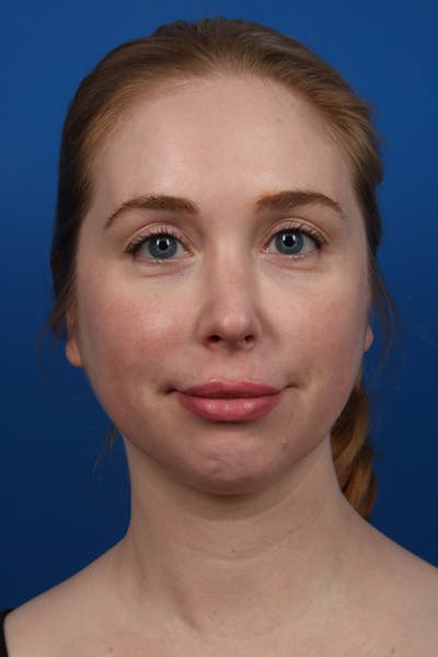 Botox Before & After Gallery - Patient 345145 - Image 1