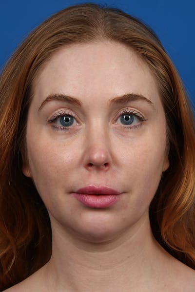 Jawline Before & After Gallery - Patient 129280 - Image 2