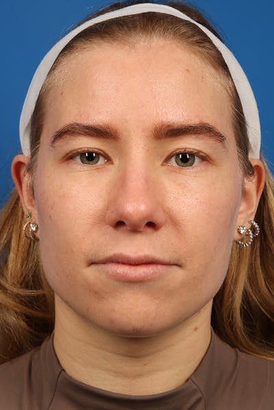 Nose Before & After Gallery - Patient 279270 - Image 2