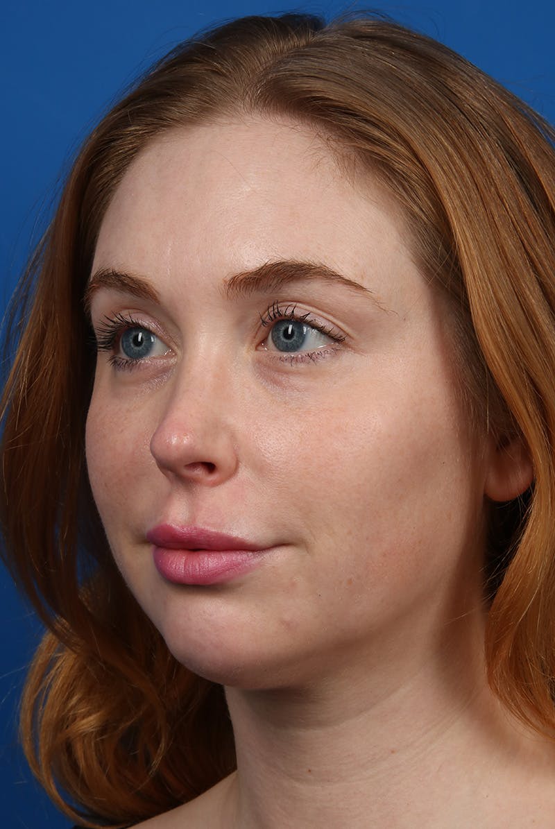 Jawline Before & After Gallery - Patient 129280 - Image 8