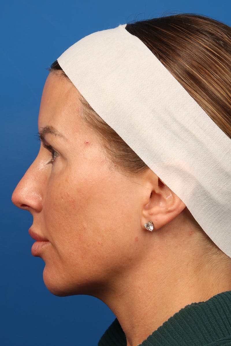 Tear Troughs Before & After Gallery - Patient 399893 - Image 9