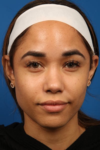 Jawline Before & After Gallery - Patient 360747 - Image 1