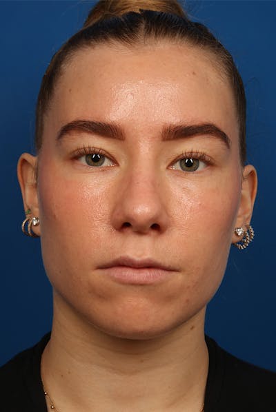 Nose Before & After Gallery - Patient 279270 - Image 1