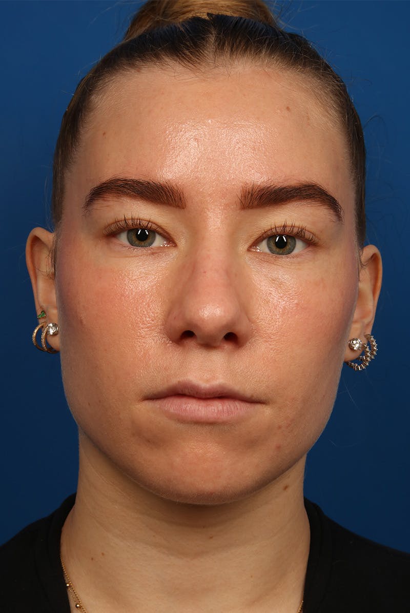 Nose Before & After Gallery - Patient 279270 - Image 1