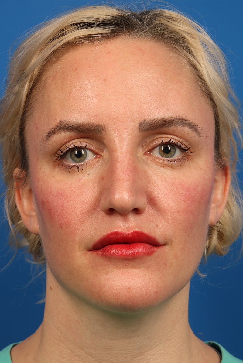 Nose Before & After Gallery - Patient 463536 - Image 2