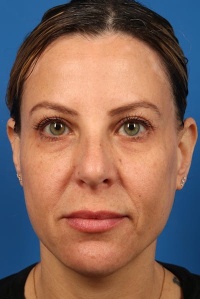 Full Face Before & After Gallery - Patient 284190 - Image 2