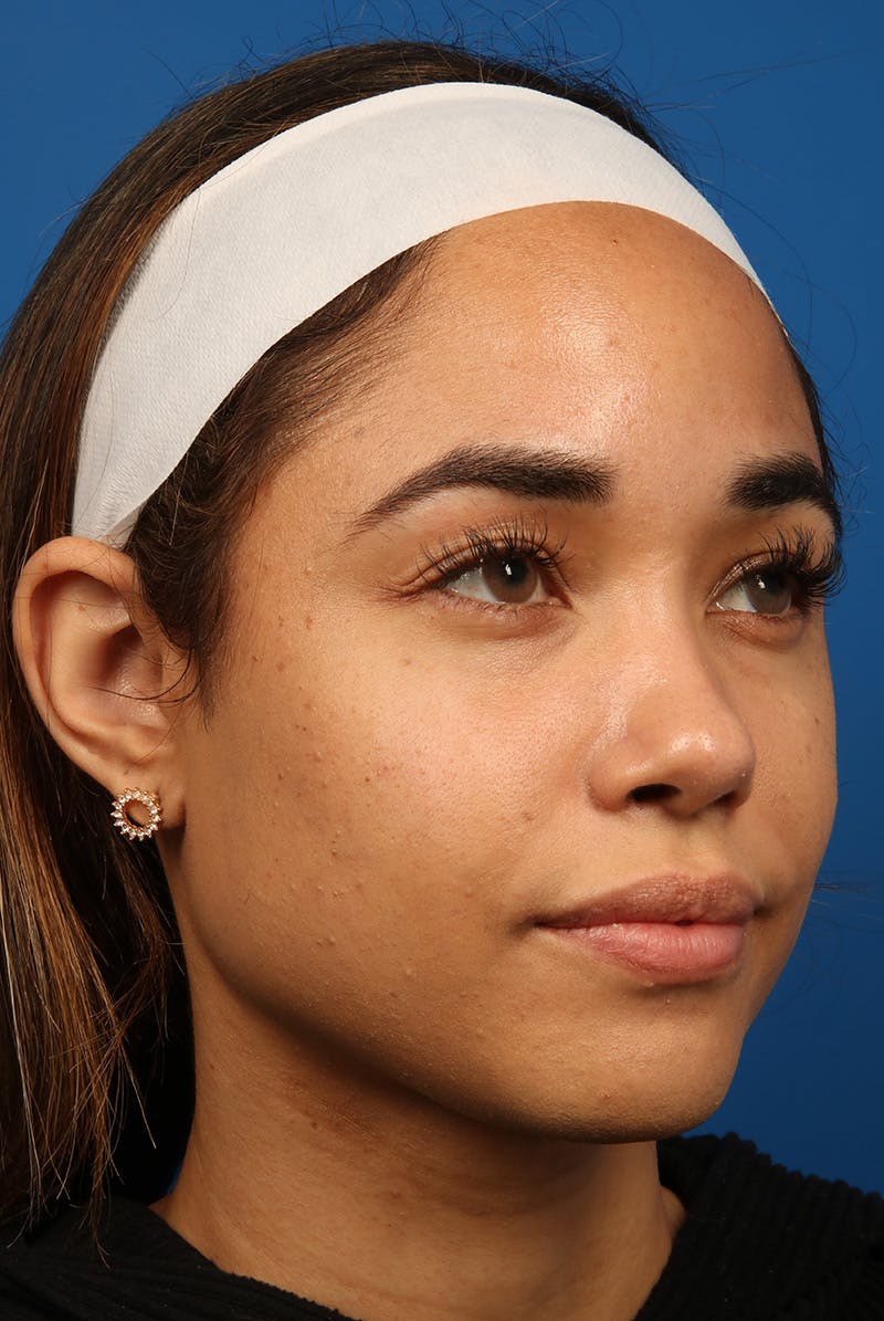 Tear Troughs Before & After Gallery - Patient 301103 - Image 3