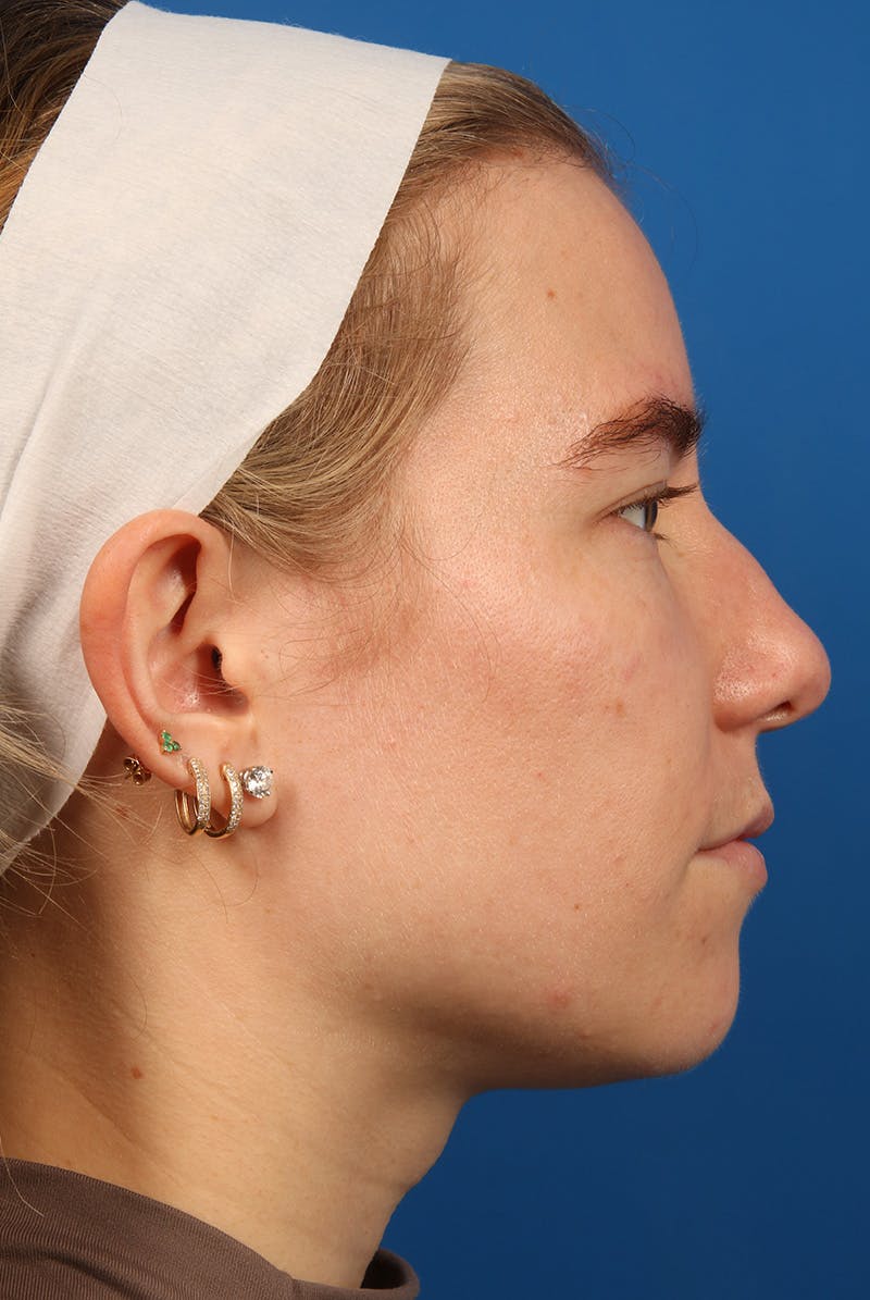 Nose Before & After Gallery - Patient 279270 - Image 6