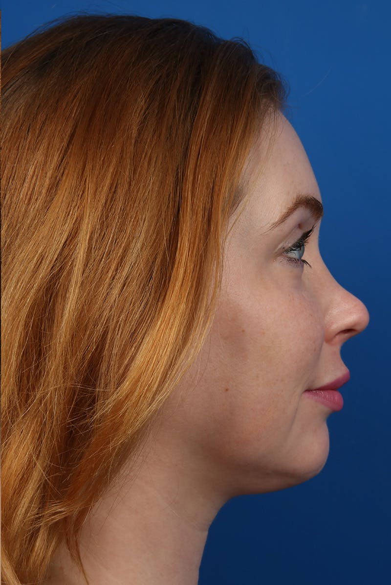 Jawline Before & After Gallery - Patient 129280 - Image 6
