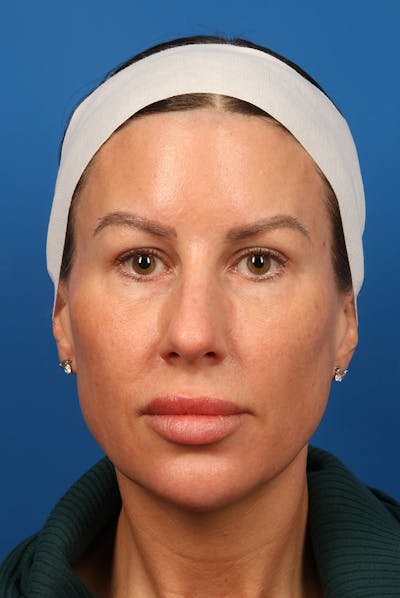 Chin Before & After Gallery - Patient 134524 - Image 1