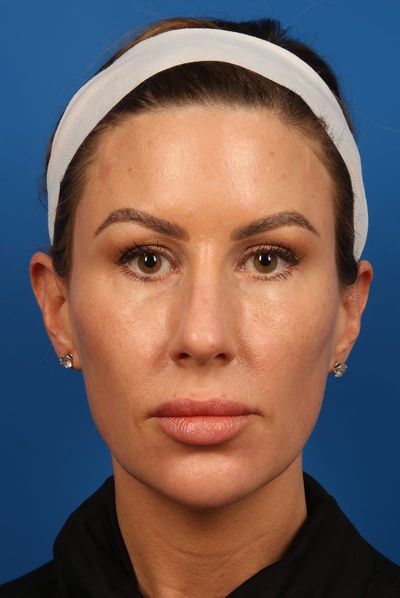 Tear Troughs Before & After Gallery - Patient 399893 - Image 2