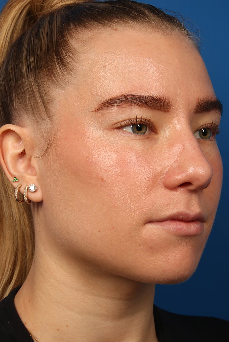 Nose Before & After Gallery - Patient 279270 - Image 3