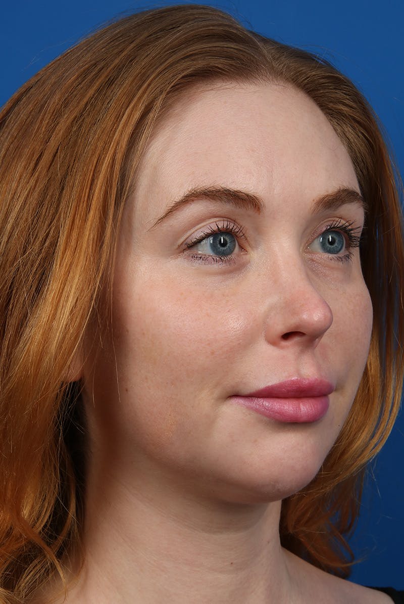 Jawline Before & After Gallery - Patient 129280 - Image 4