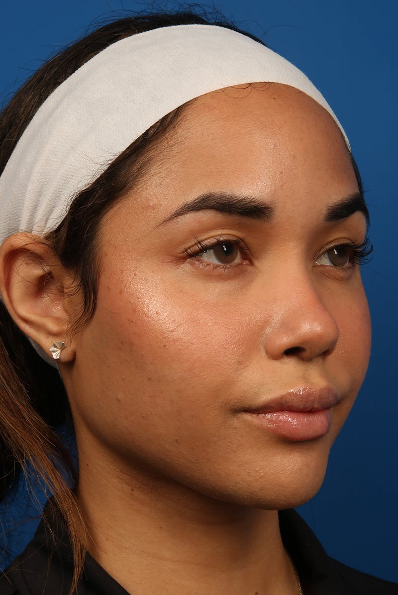 Tear Troughs Before & After Gallery - Patient 301103 - Image 4