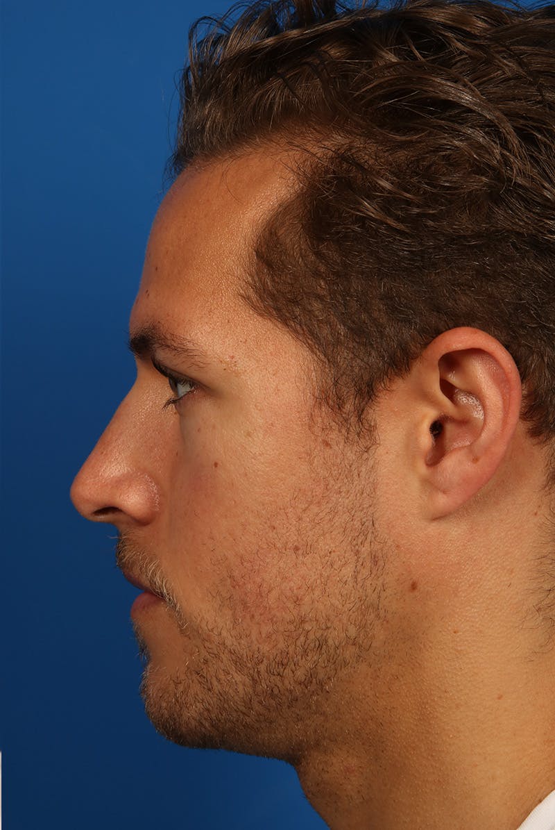 Chin Before & After Gallery - Patient 259584 - Image 5