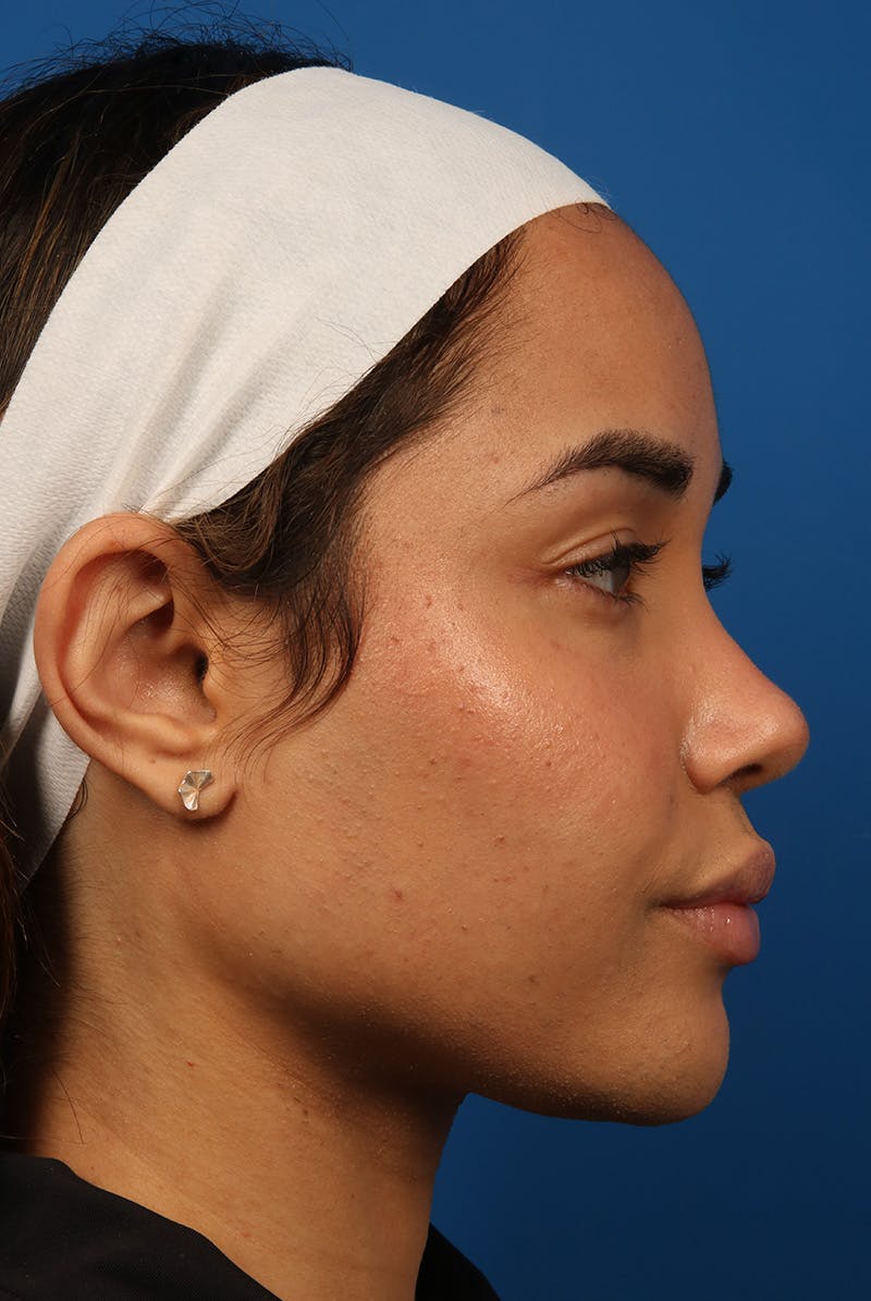 Tear Troughs Before & After Gallery - Patient 301103 - Image 6