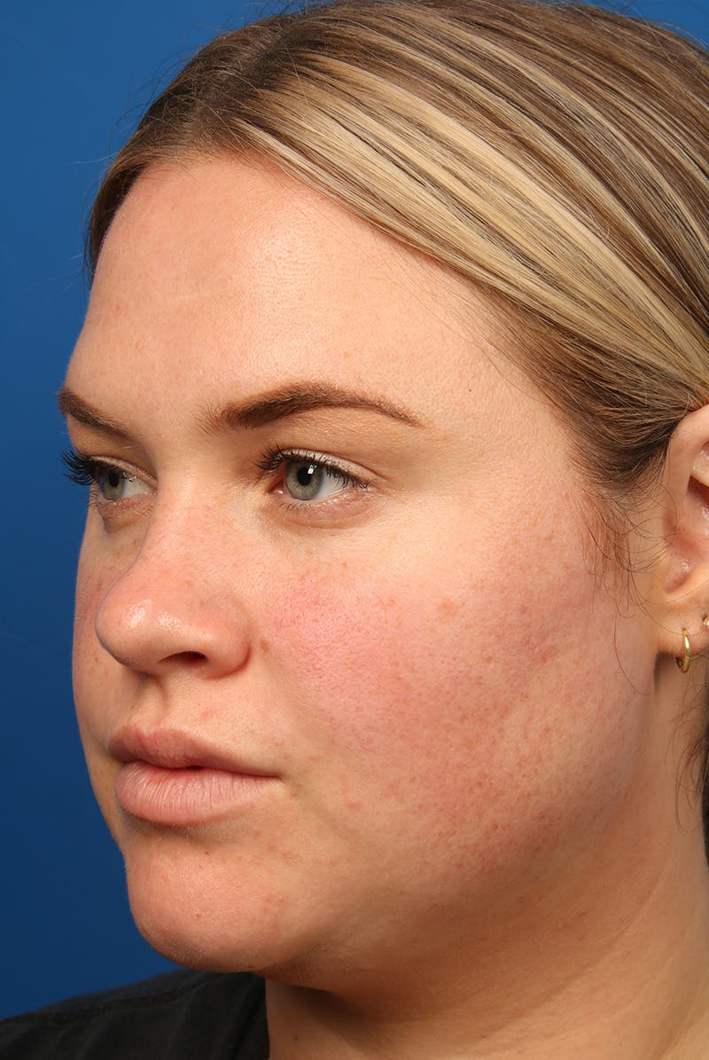 Tear Troughs Before & After Gallery - Patient 216553 - Image 7