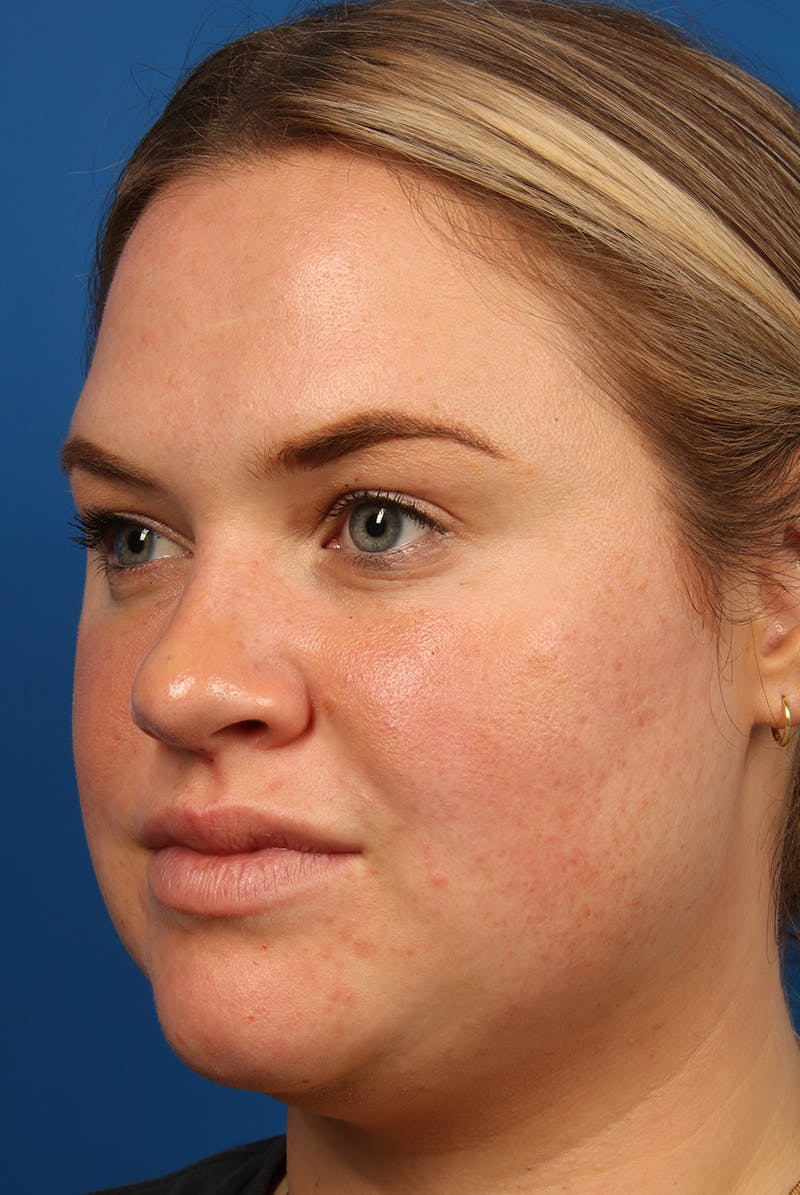 Tear Troughs Before & After Gallery - Patient 216553 - Image 8